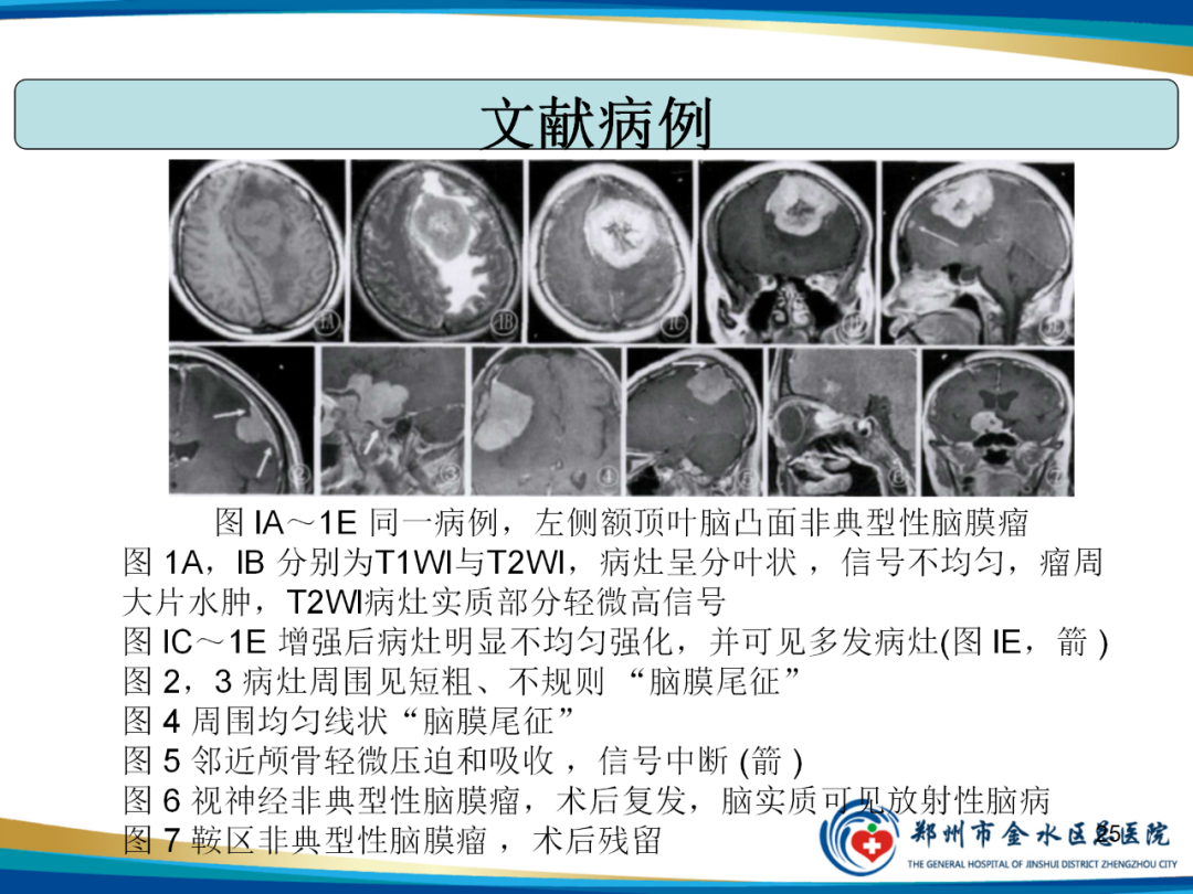 【PPT】非典型脑膜瘤影像学诊断-25