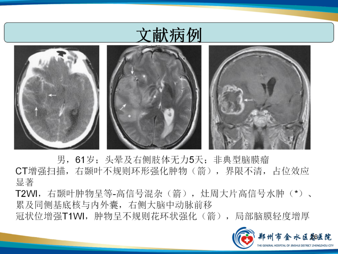 【PPT】非典型脑膜瘤影像学诊断-26