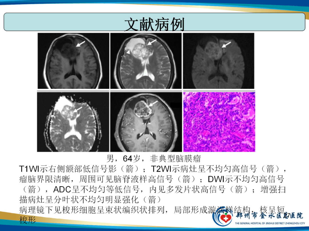 【PPT】非典型脑膜瘤影像学诊断-27