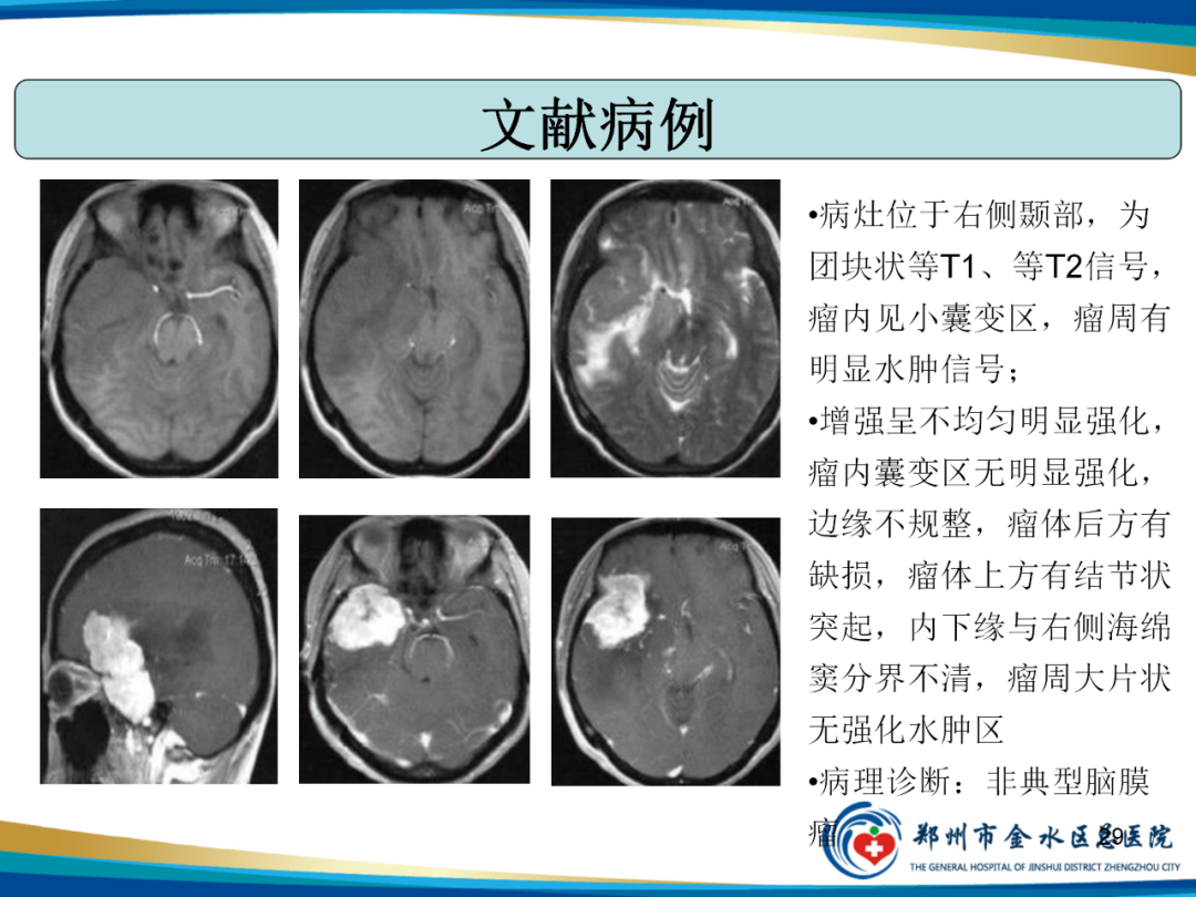 【PPT】非典型脑膜瘤影像学诊断-29