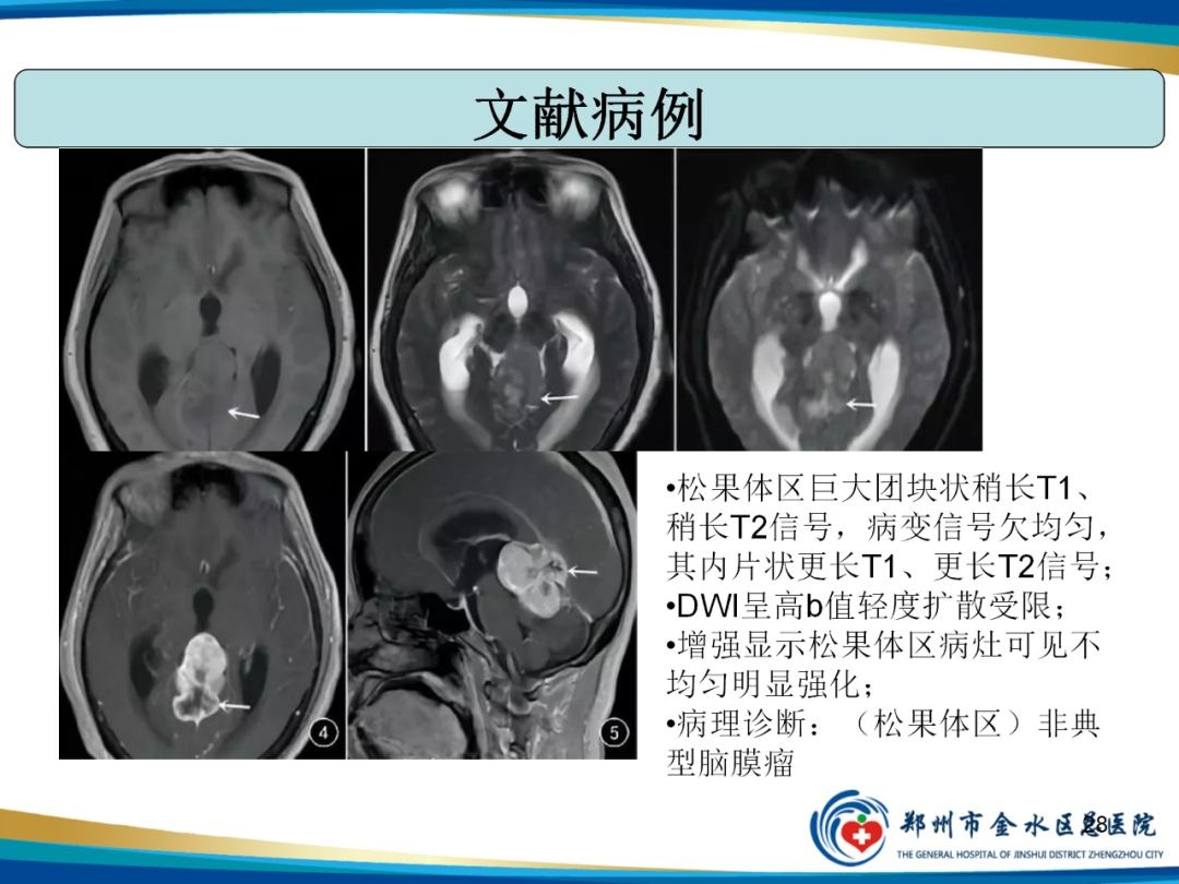 【PPT】非典型脑膜瘤影像学诊断-28