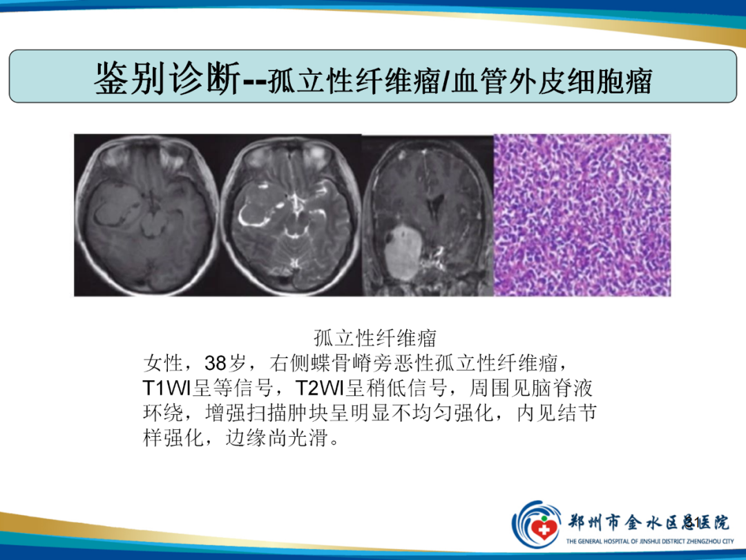 【PPT】非典型脑膜瘤影像学诊断-31