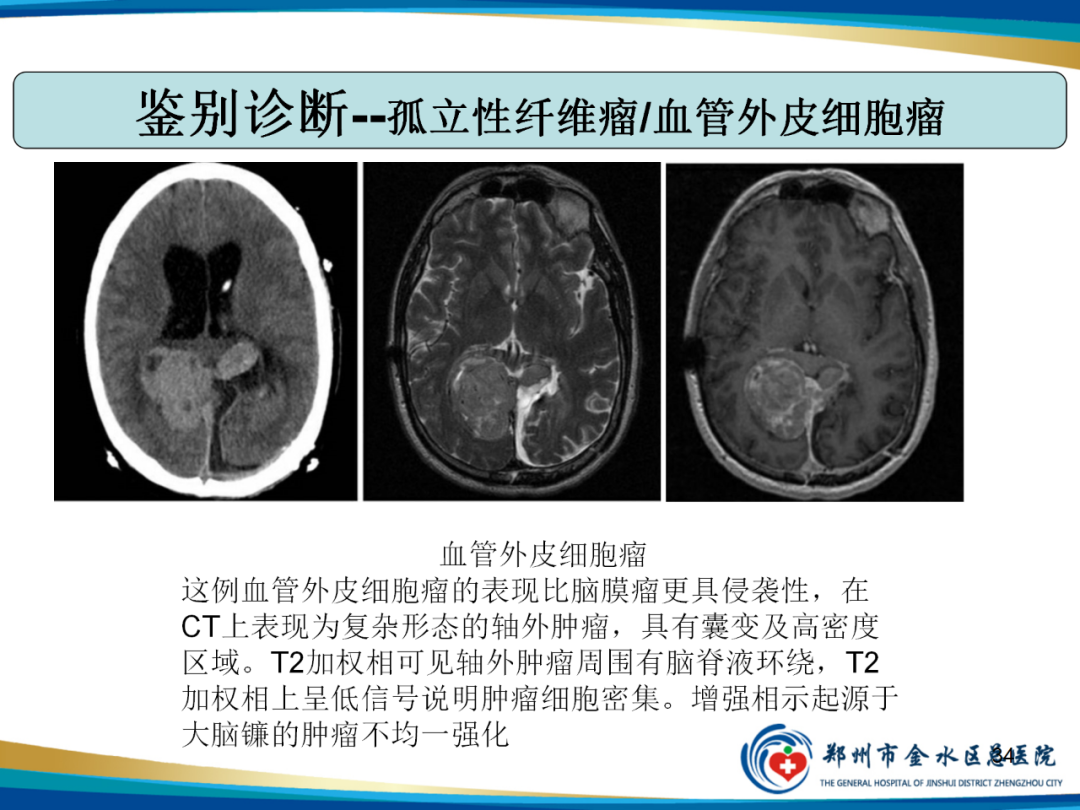 【PPT】非典型脑膜瘤影像学诊断-34