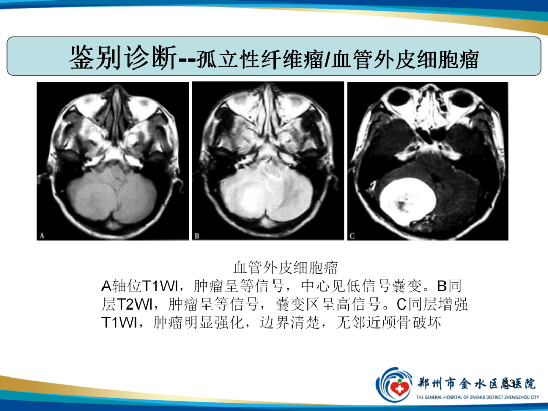 【PPT】非典型脑膜瘤影像学诊断-33