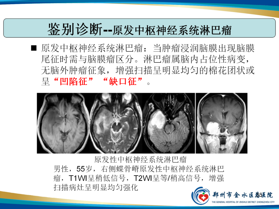 【PPT】非典型脑膜瘤影像学诊断-35