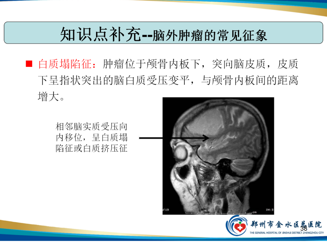 【PPT】非典型脑膜瘤影像学诊断-38