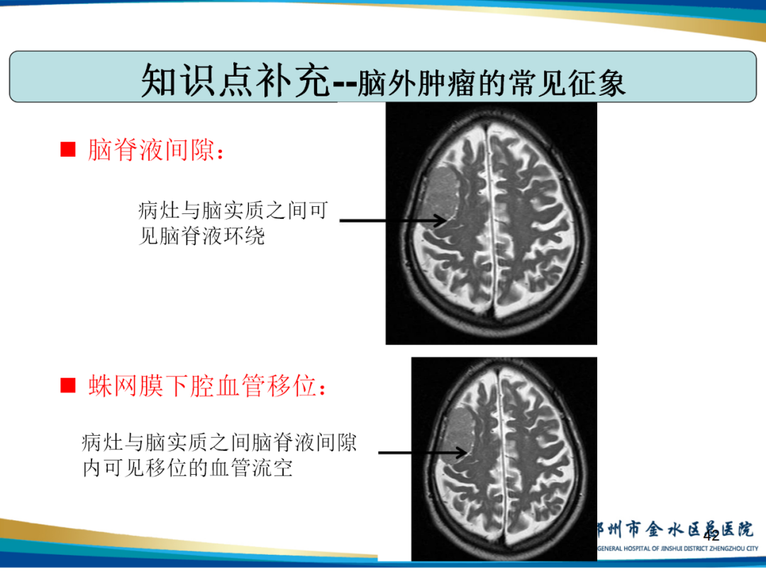 【PPT】非典型脑膜瘤影像学诊断-42