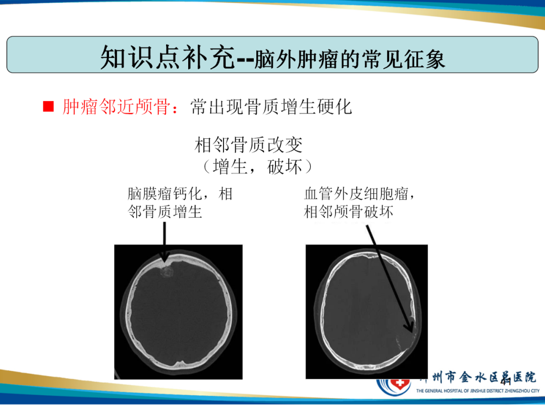 【PPT】非典型脑膜瘤影像学诊断-41