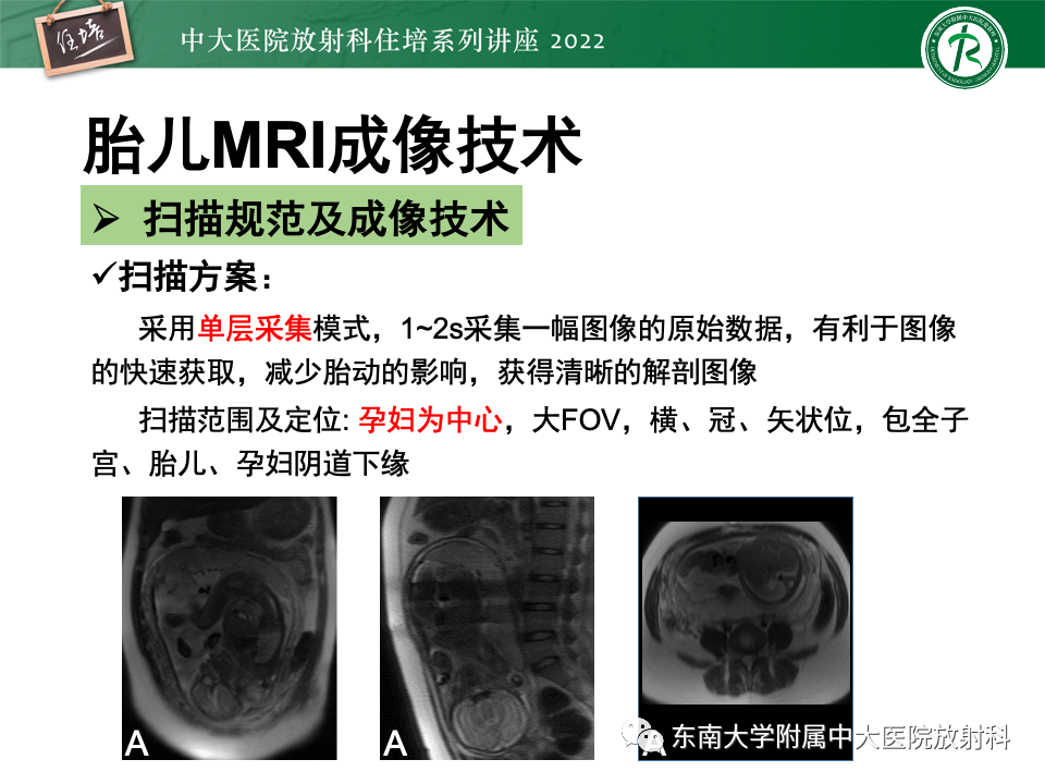 【PPT】胎儿颅脑MRI技术及常见神经系统发育异常-17