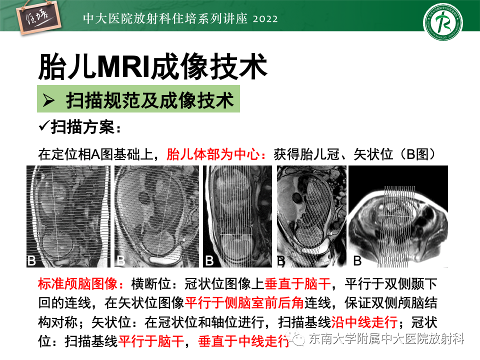 【PPT】胎儿颅脑MRI技术及常见神经系统发育异常-18