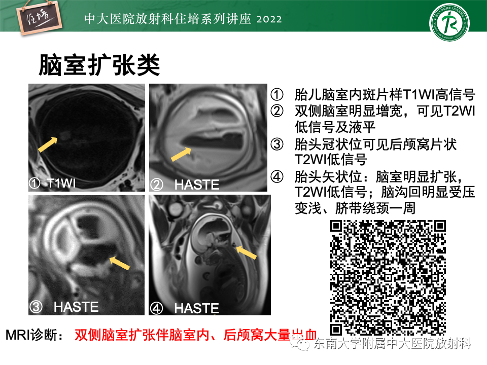 【PPT】胎儿颅脑MRI技术及常见神经系统发育异常-5