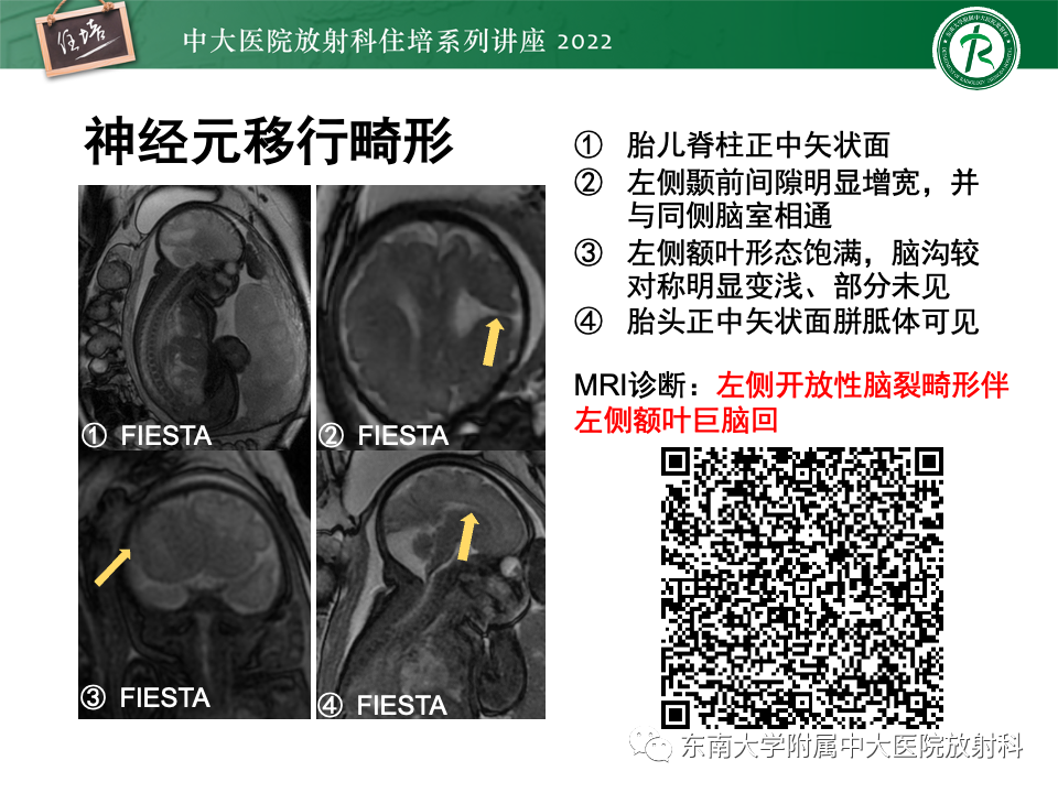 【PPT】胎儿颅脑MRI技术及常见神经系统发育异常-1