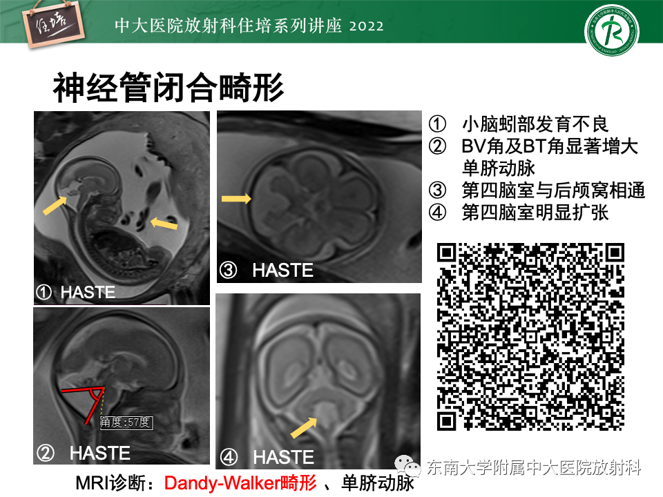 【PPT】胎儿颅脑MRI技术及常见神经系统发育异常-3