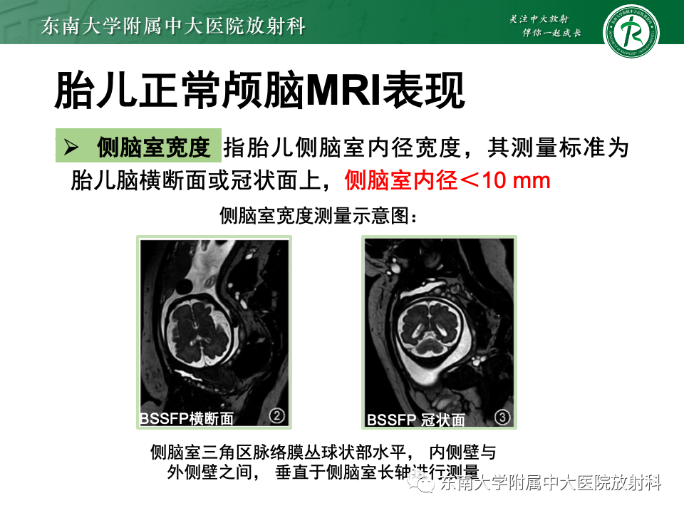 【PPT】胎儿颅脑MRI技术及常见神经系统发育异常-12