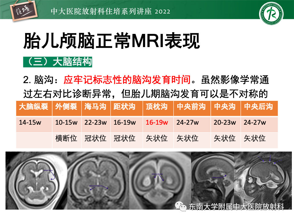 【PPT】胎儿颅脑MRI技术及常见神经系统发育异常-16