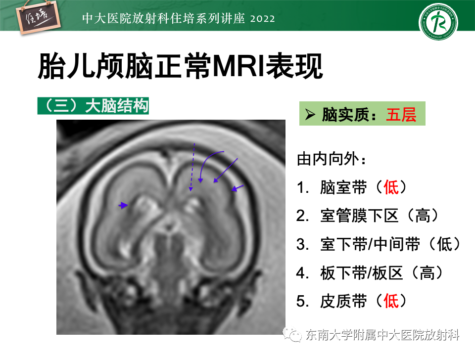 【PPT】胎儿颅脑MRI技术及常见神经系统发育异常-15