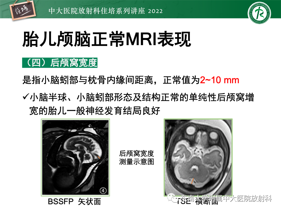 【PPT】胎儿颅脑MRI技术及常见神经系统发育异常-18
