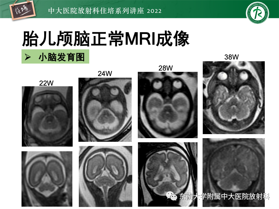 【PPT】胎儿颅脑MRI技术及常见神经系统发育异常-20