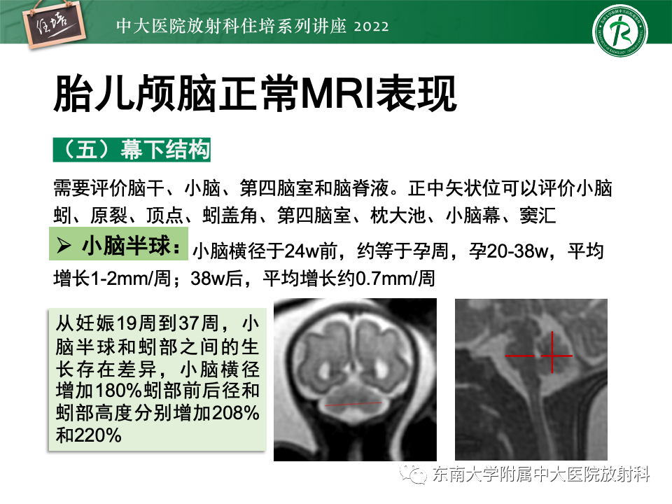 【PPT】胎儿颅脑MRI技术及常见神经系统发育异常-19