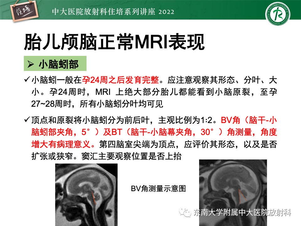 【PPT】胎儿颅脑MRI技术及常见神经系统发育异常-21