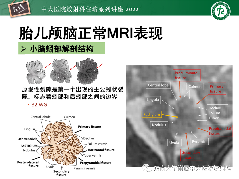 【PPT】胎儿颅脑MRI技术及常见神经系统发育异常-22