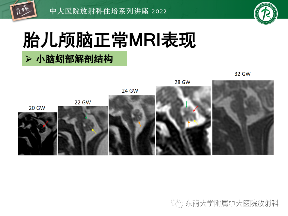 【PPT】胎儿颅脑MRI技术及常见神经系统发育异常-23