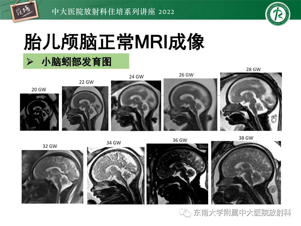 【PPT】胎儿颅脑MRI技术及常见神经系统发育异常-24