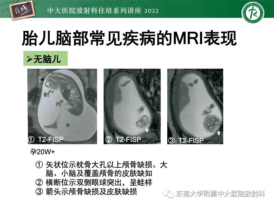 【PPT】胎儿颅脑MRI技术及常见神经系统发育异常-28