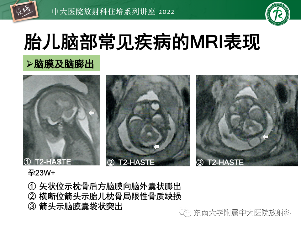 【PPT】胎儿颅脑MRI技术及常见神经系统发育异常-30