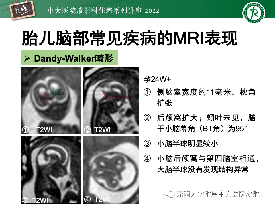【PPT】胎儿颅脑MRI技术及常见神经系统发育异常-32