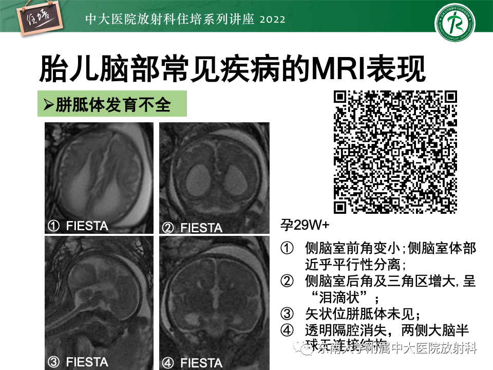 【PPT】胎儿颅脑MRI技术及常见神经系统发育异常-34