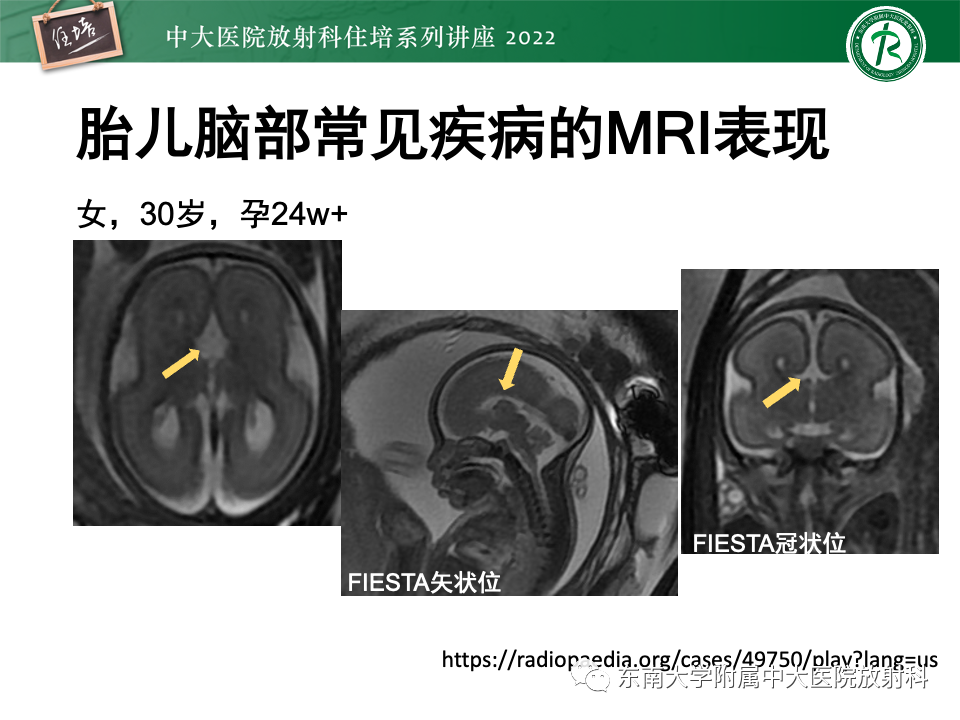 【PPT】胎儿颅脑MRI技术及常见神经系统发育异常-35