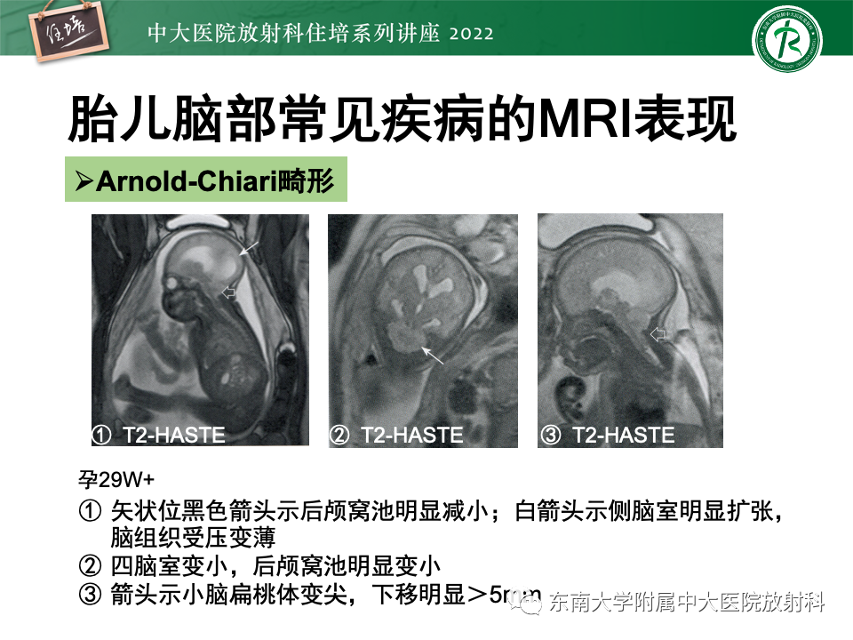 【PPT】胎儿颅脑MRI技术及常见神经系统发育异常-37