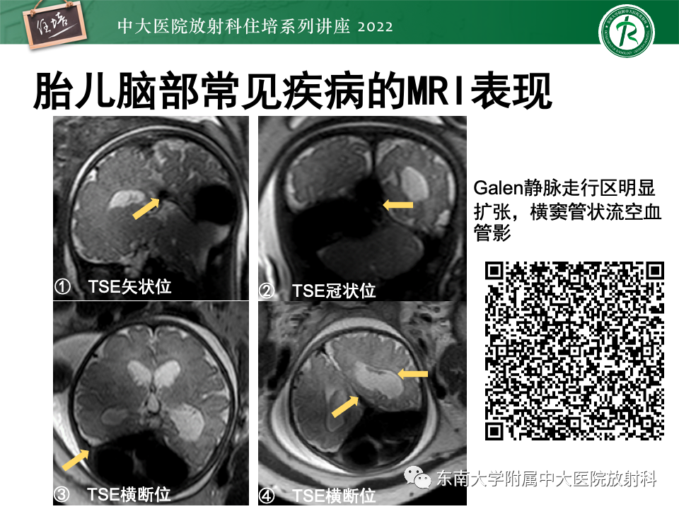 【PPT】胎儿颅脑MRI技术及常见神经系统发育异常-46
