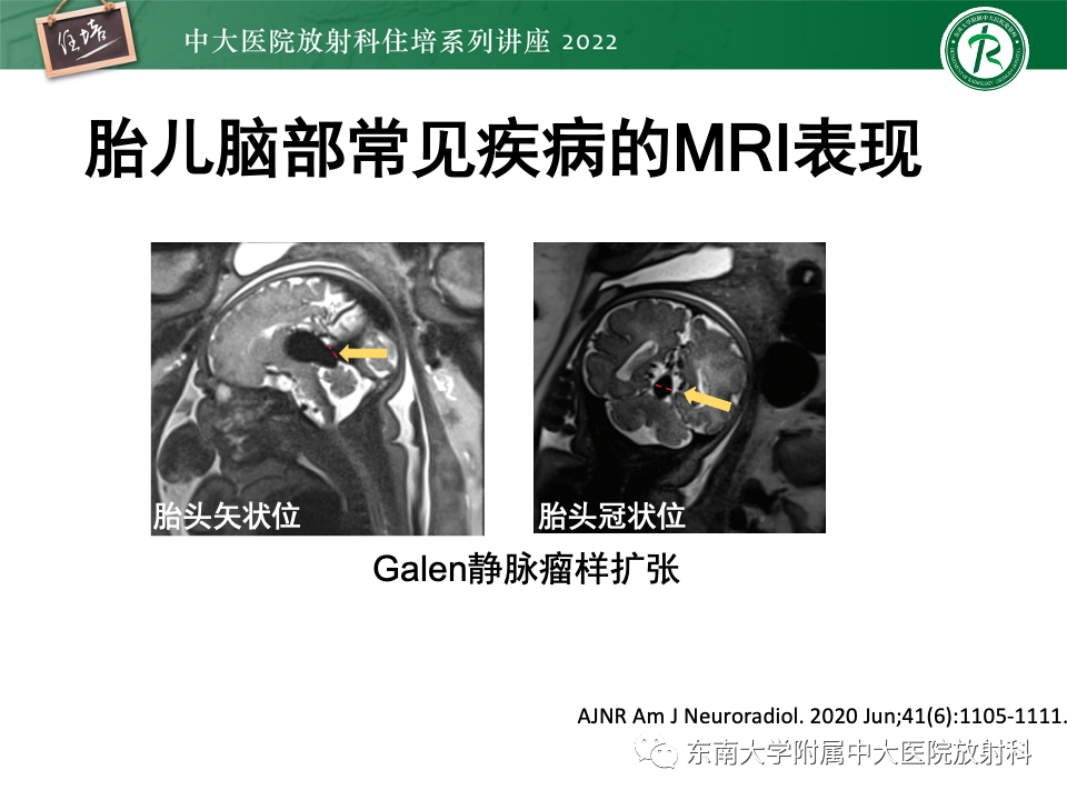 【PPT】胎儿颅脑MRI技术及常见神经系统发育异常-47