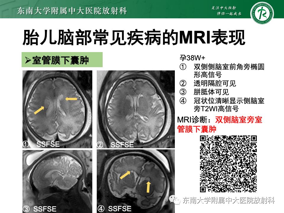 【PPT】胎儿颅脑MRI技术及常见神经系统发育异常-49