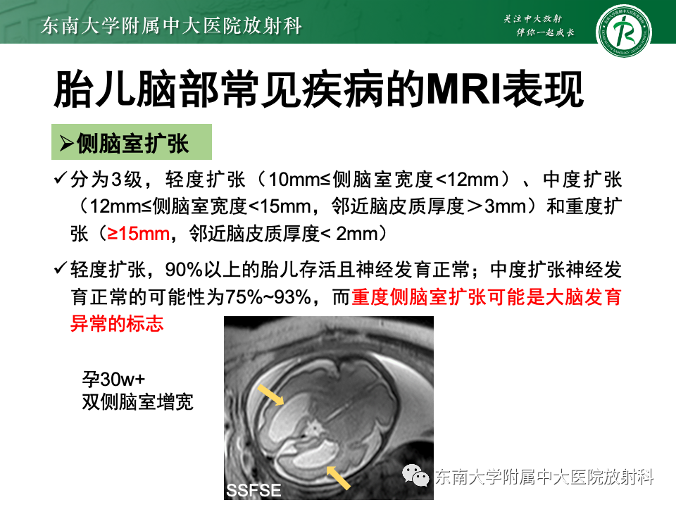 【PPT】胎儿颅脑MRI技术及常见神经系统发育异常-50