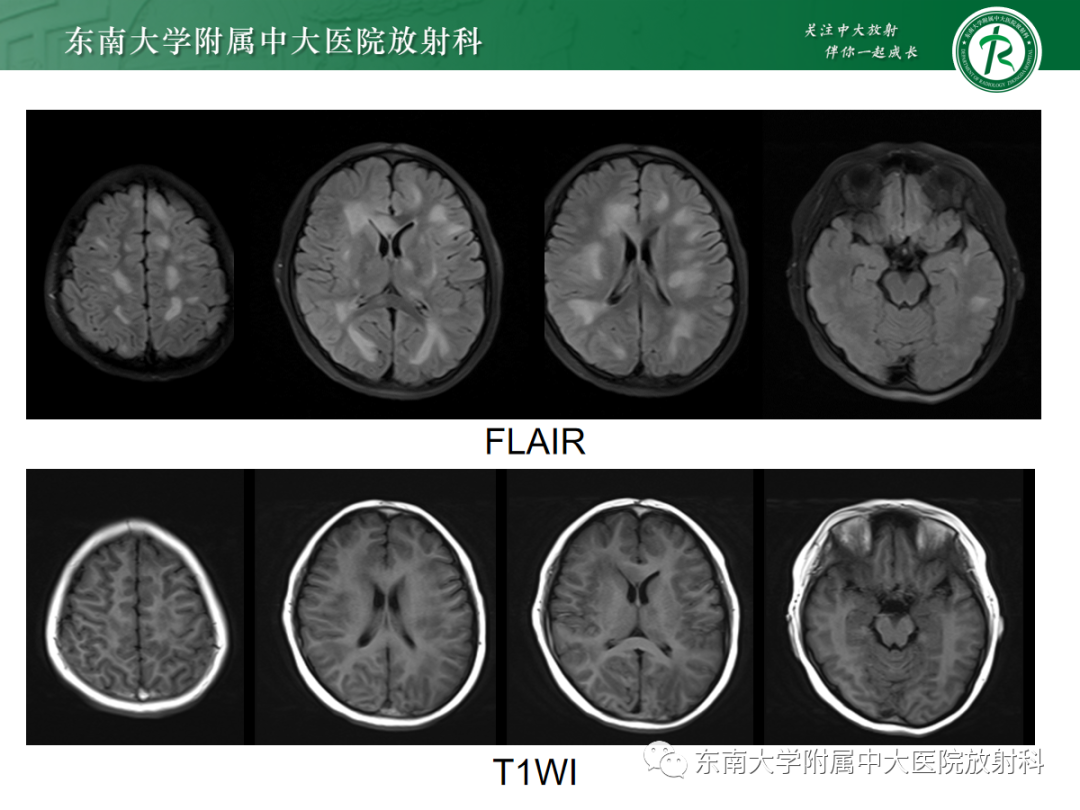 【PPT】皮层下U形纤维受累常见病变-2