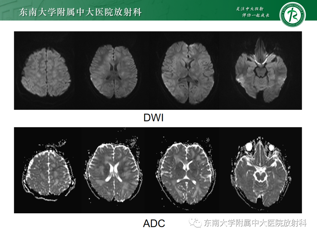 【PPT】皮层下U形纤维受累常见病变-3