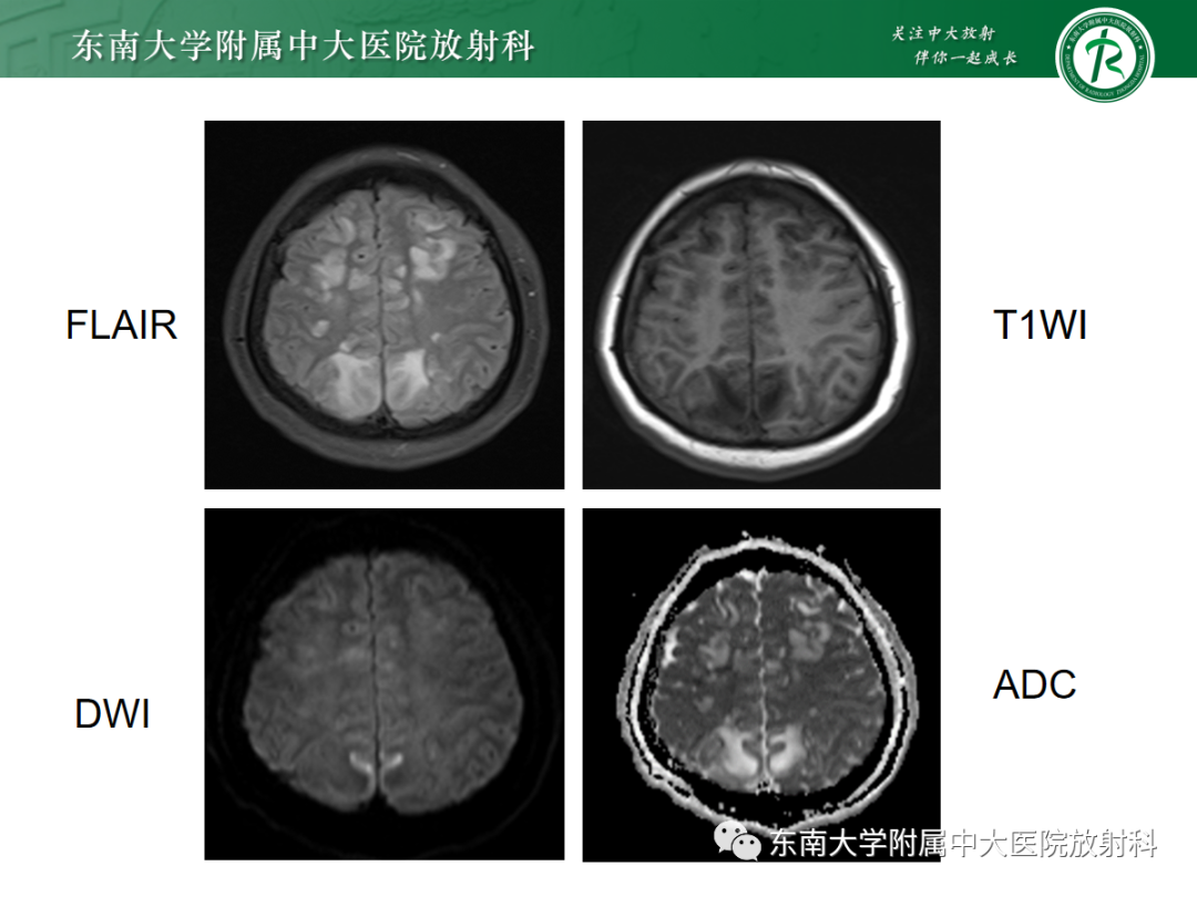 【PPT】皮层下U形纤维受累常见病变-5