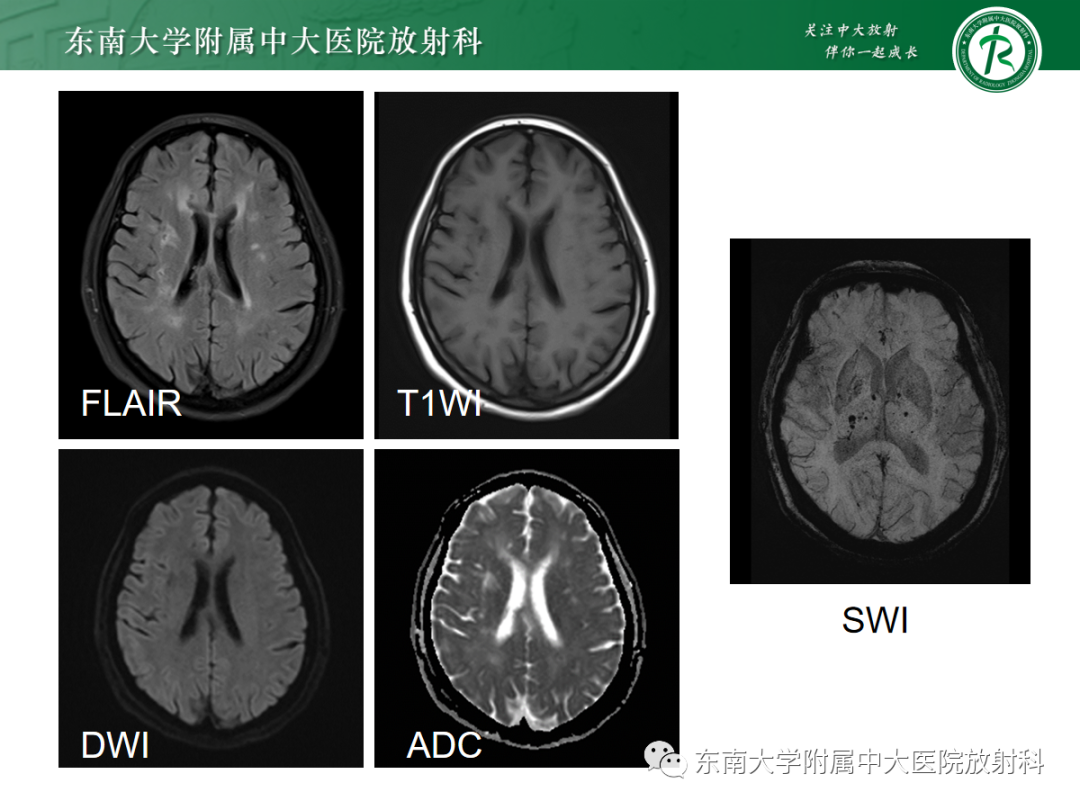 【PPT】皮层下U形纤维受累常见病变-8