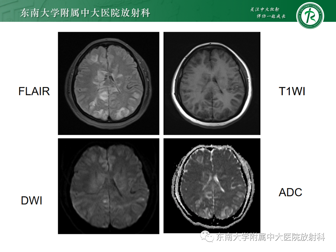 【PPT】皮层下U形纤维受累常见病变-6