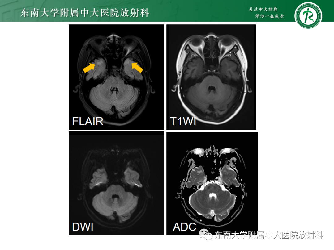 【PPT】皮层下U形纤维受累常见病变-9