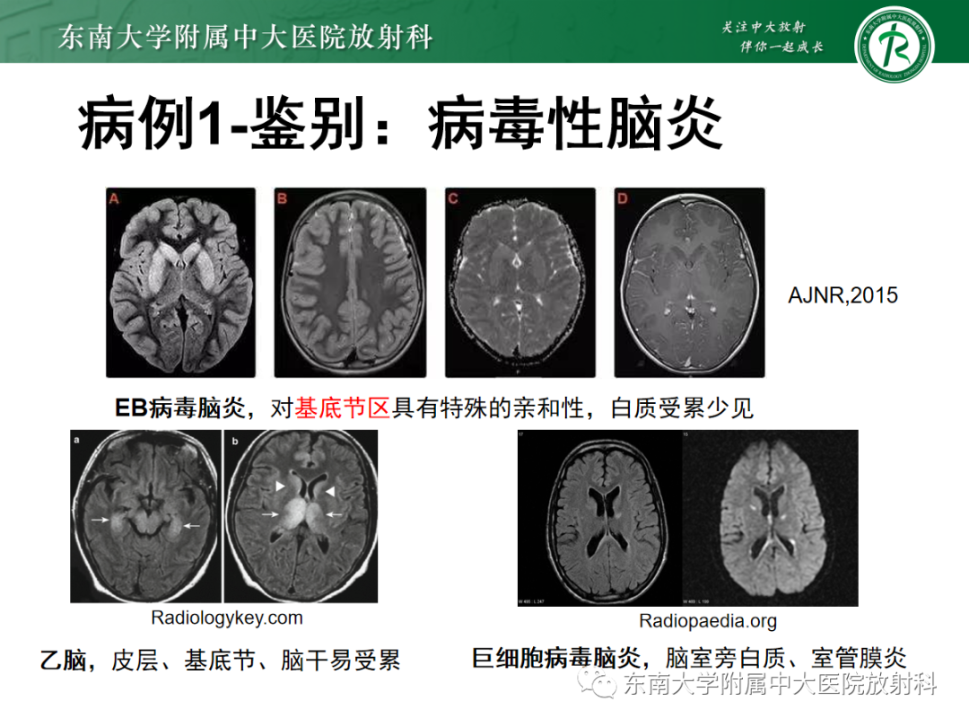 【PPT】皮层下U形纤维受累常见病变-14