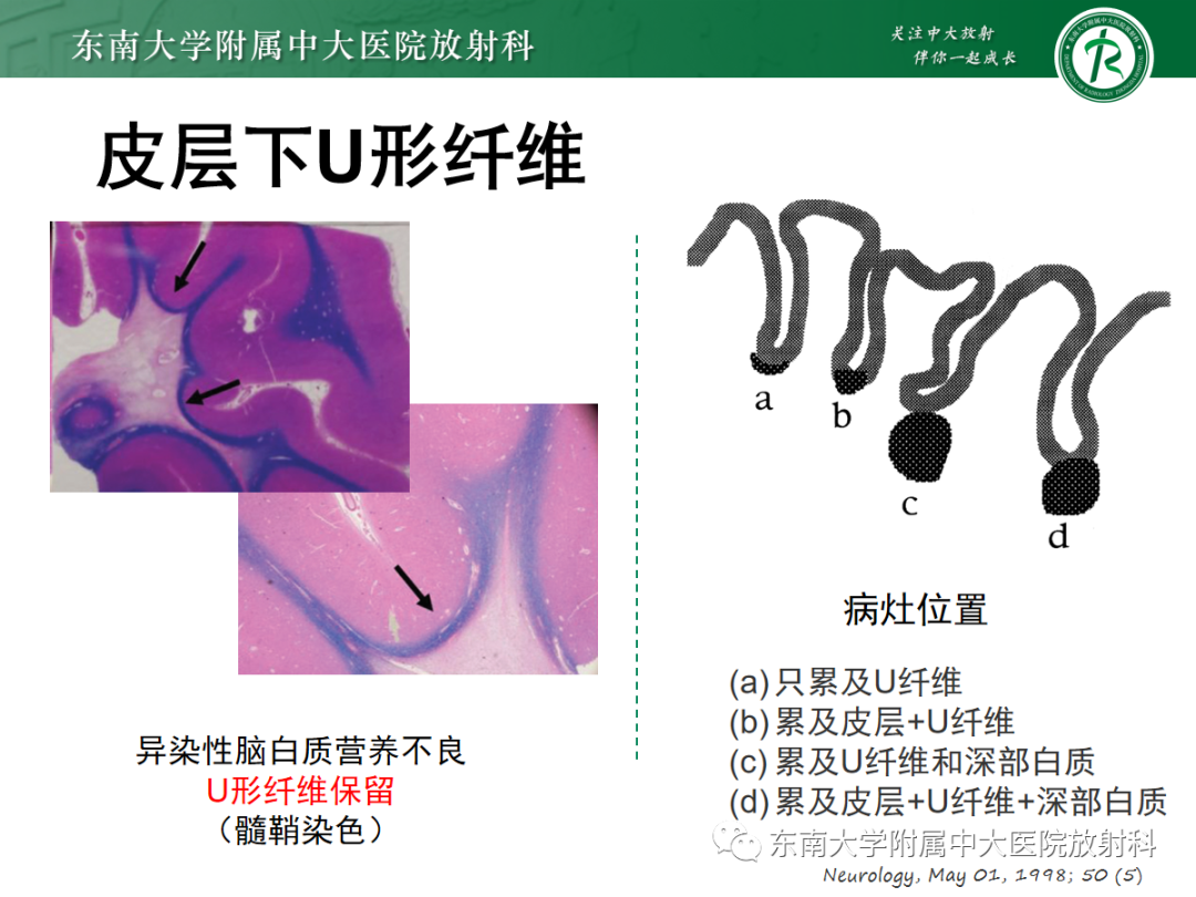 【PPT】皮层下U形纤维受累常见病变-18