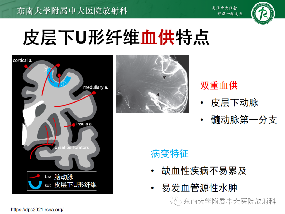 【PPT】皮层下U形纤维受累常见病变-22