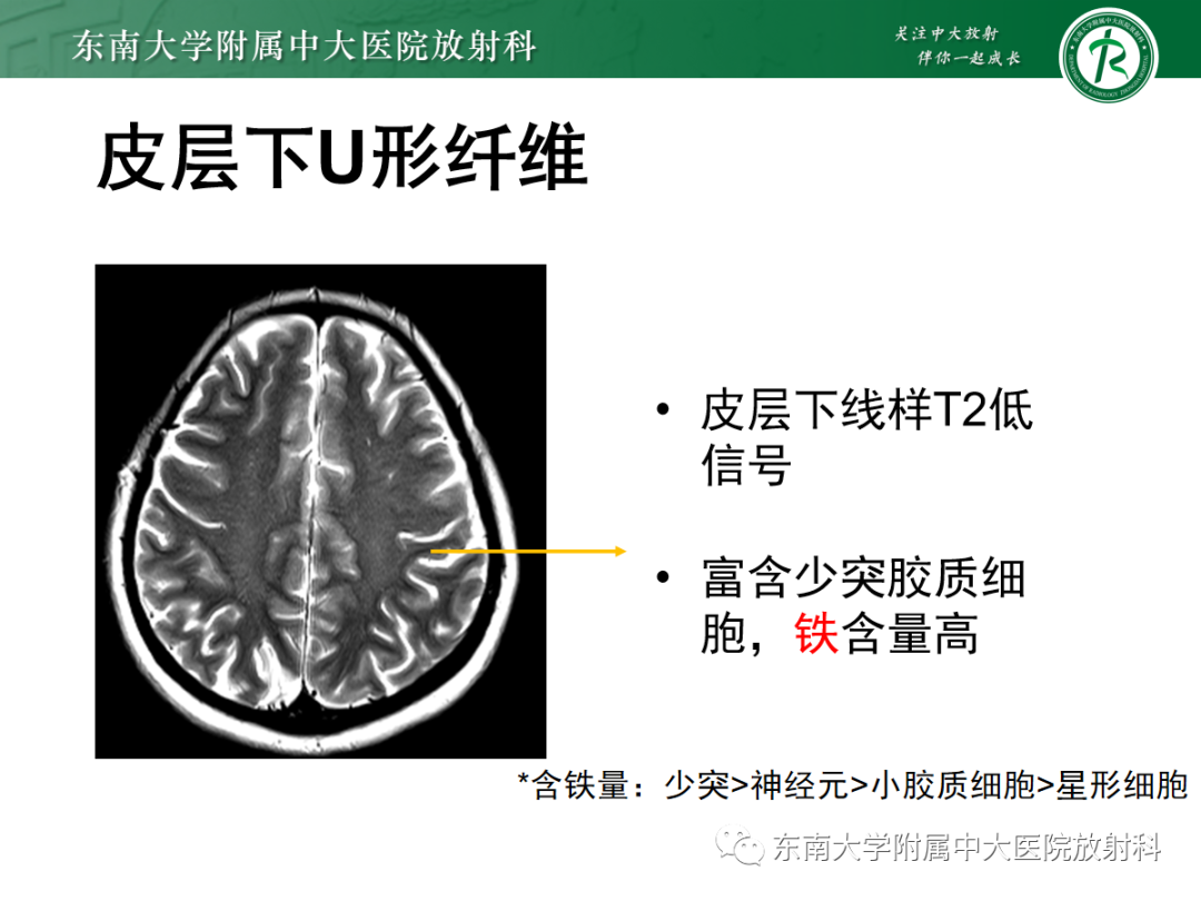 【PPT】皮层下U形纤维受累常见病变-19