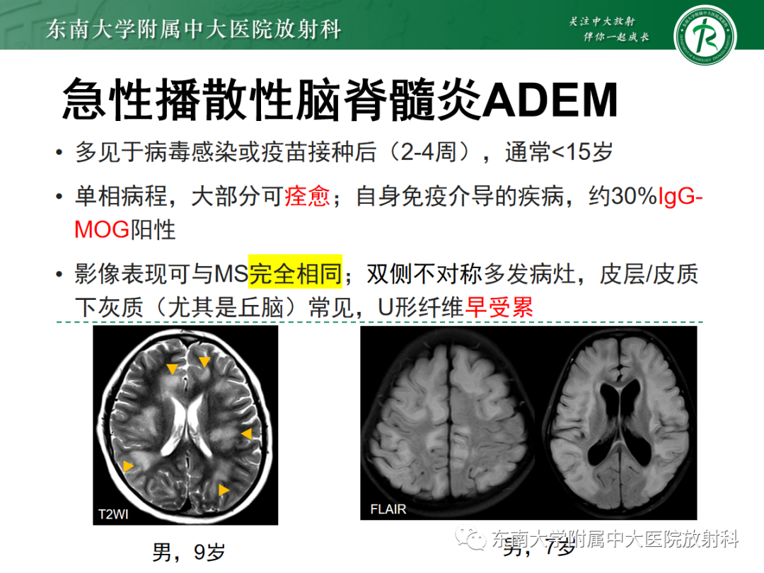 【PPT】皮层下U形纤维受累常见病变-26