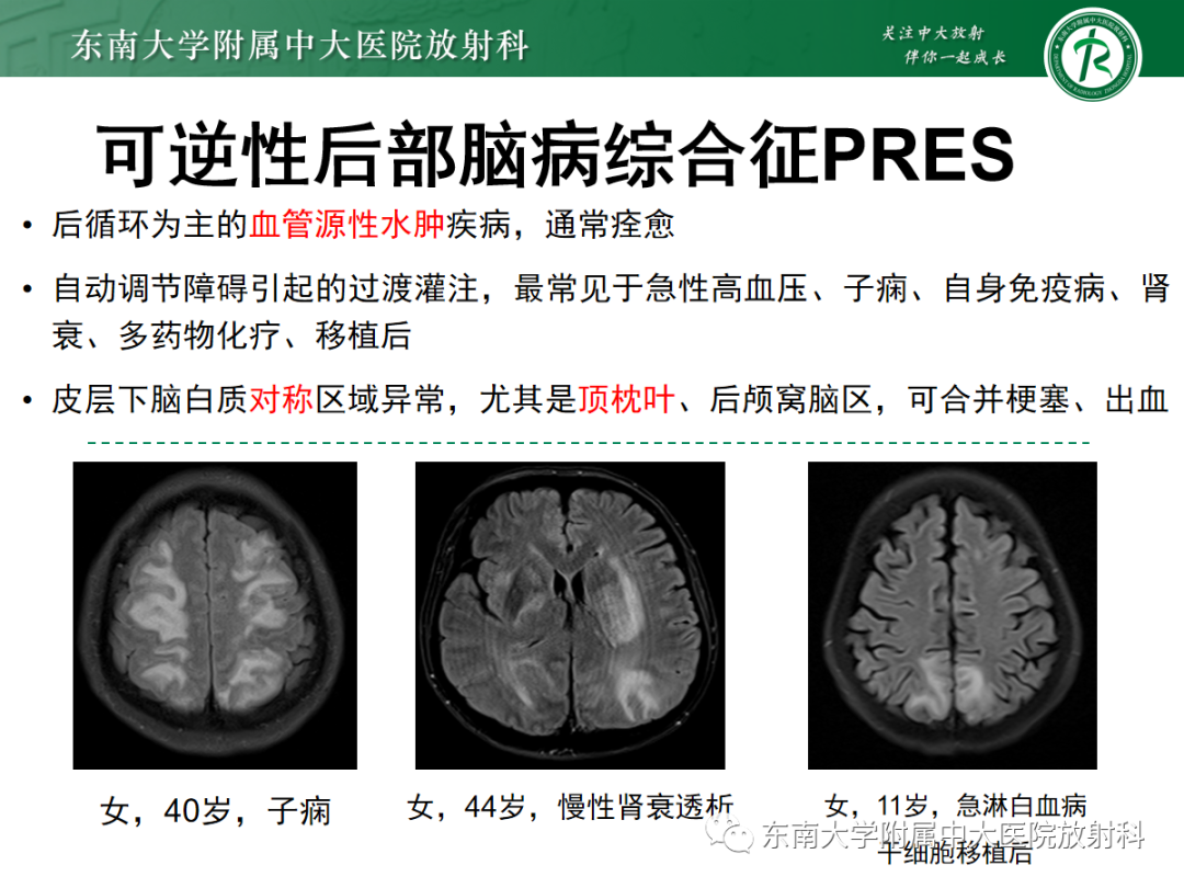 【PPT】皮层下U形纤维受累常见病变-28