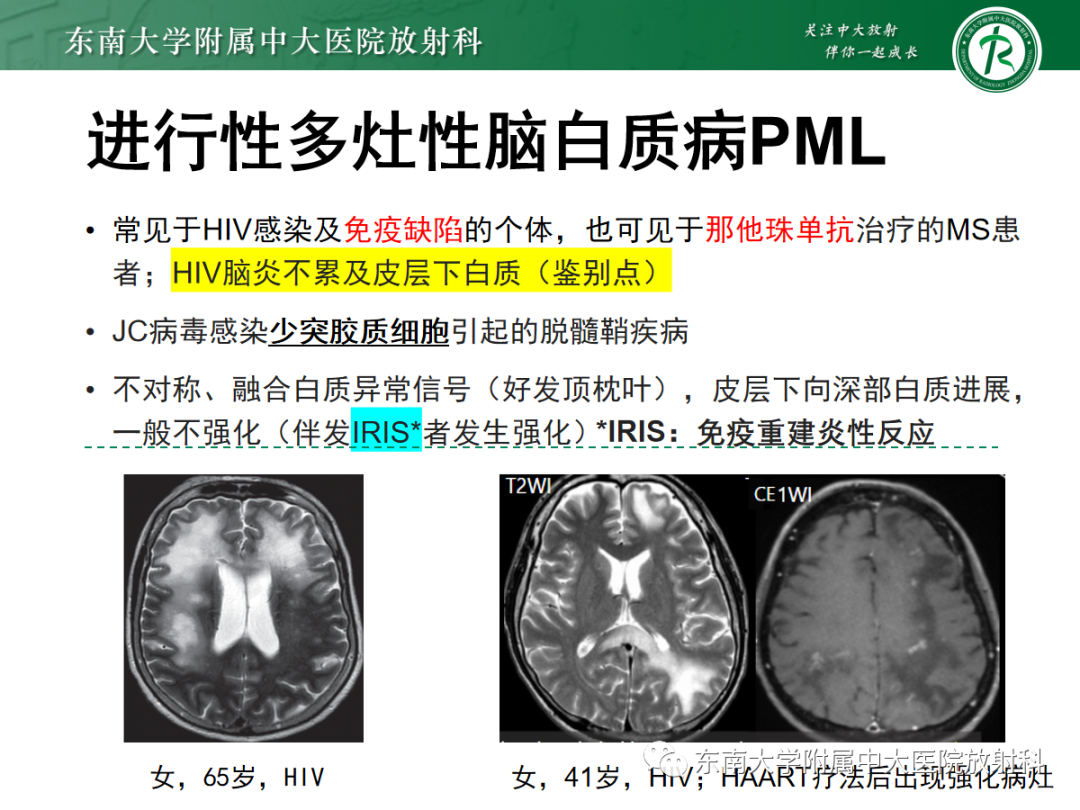 【PPT】皮层下U形纤维受累常见病变-27